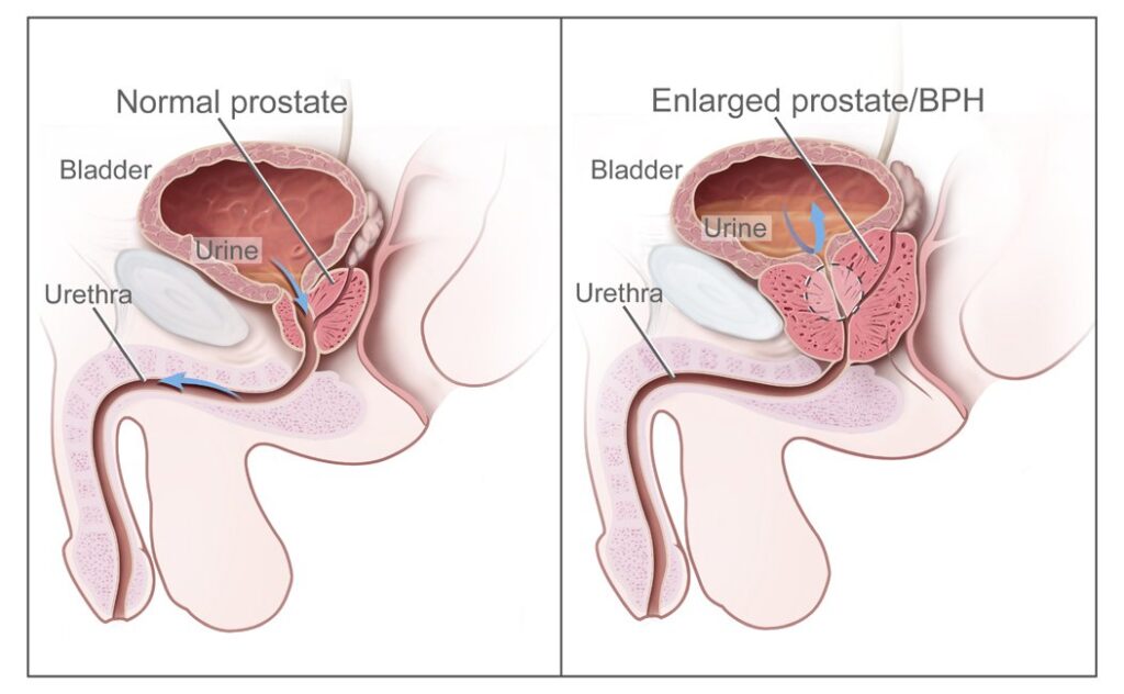 Clinical expertise benign prostatic hyperplasia