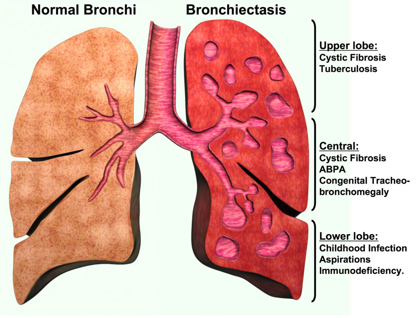 Clinical expertise bronchiectasis