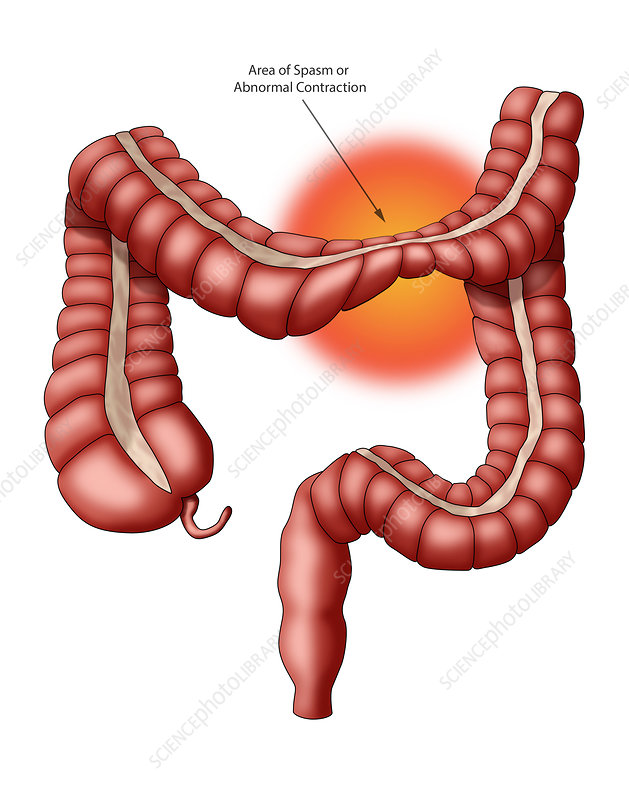Clinical expertise irritable bowel syndrome (ibs), illustration