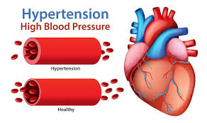 Clinical expertise hypertension