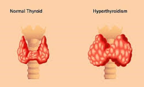 Clinical expertise hyperthyroidism