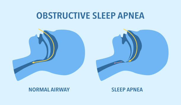 Clinical expertise obstructive sleep apnea concept. sleep disorder.